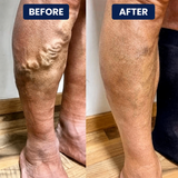 Varicose™ Vein Relief Patches for Legs(Pack of 10)