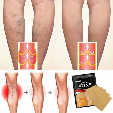 Hanel™ VeinEase Comfort Patches (Buy 1 Get 1 = 24 Patches)