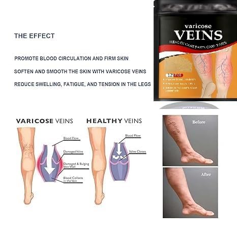 Hanel™ Varicose Veins Relief Patches - Reduces Swelling, Relieves Pain, Improves Blood Circulation & Vein Health | Herbal, Skin-Friendly & Instant Pain Relief (Pack of 12)