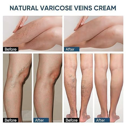Hanel™ Varicose Veins Relief Patches - Reduces Swelling, Relieves Pain, Improves Blood Circulation & Vein Health | Herbal, Skin-Friendly & Instant Pain Relief (Pack of 12)